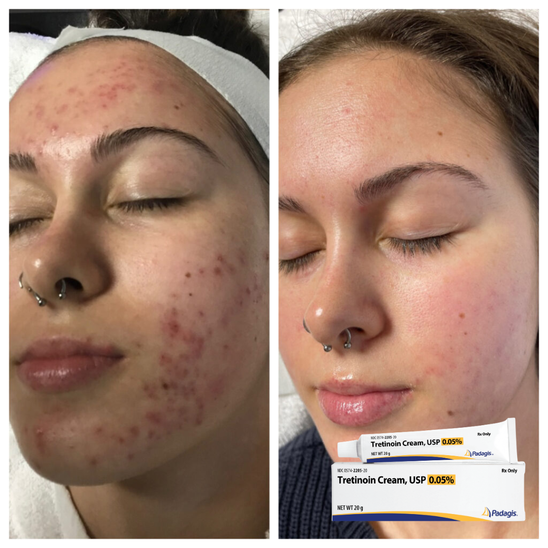 Tretinoin Cream USP