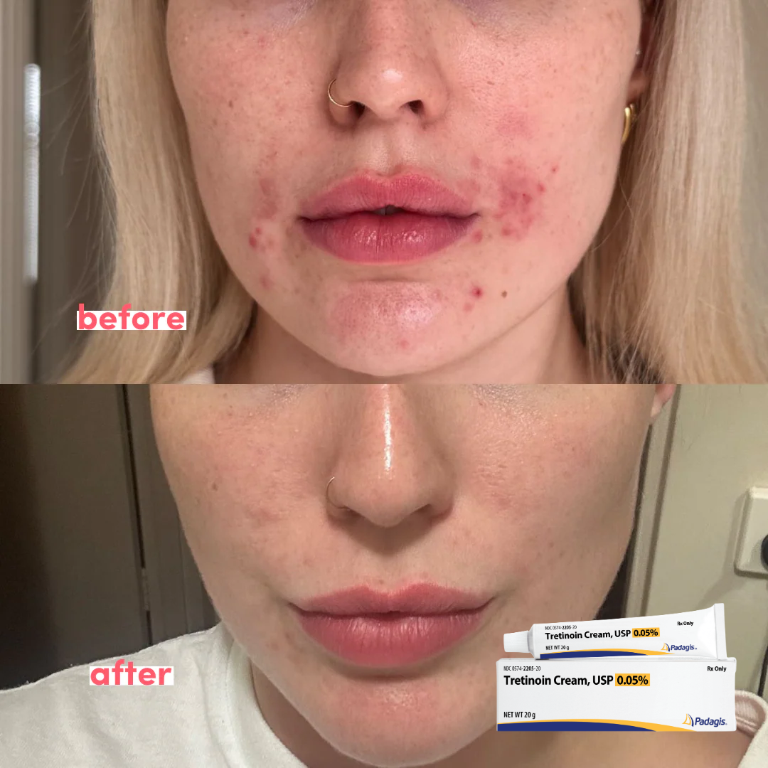 Tretinoin Cream USP