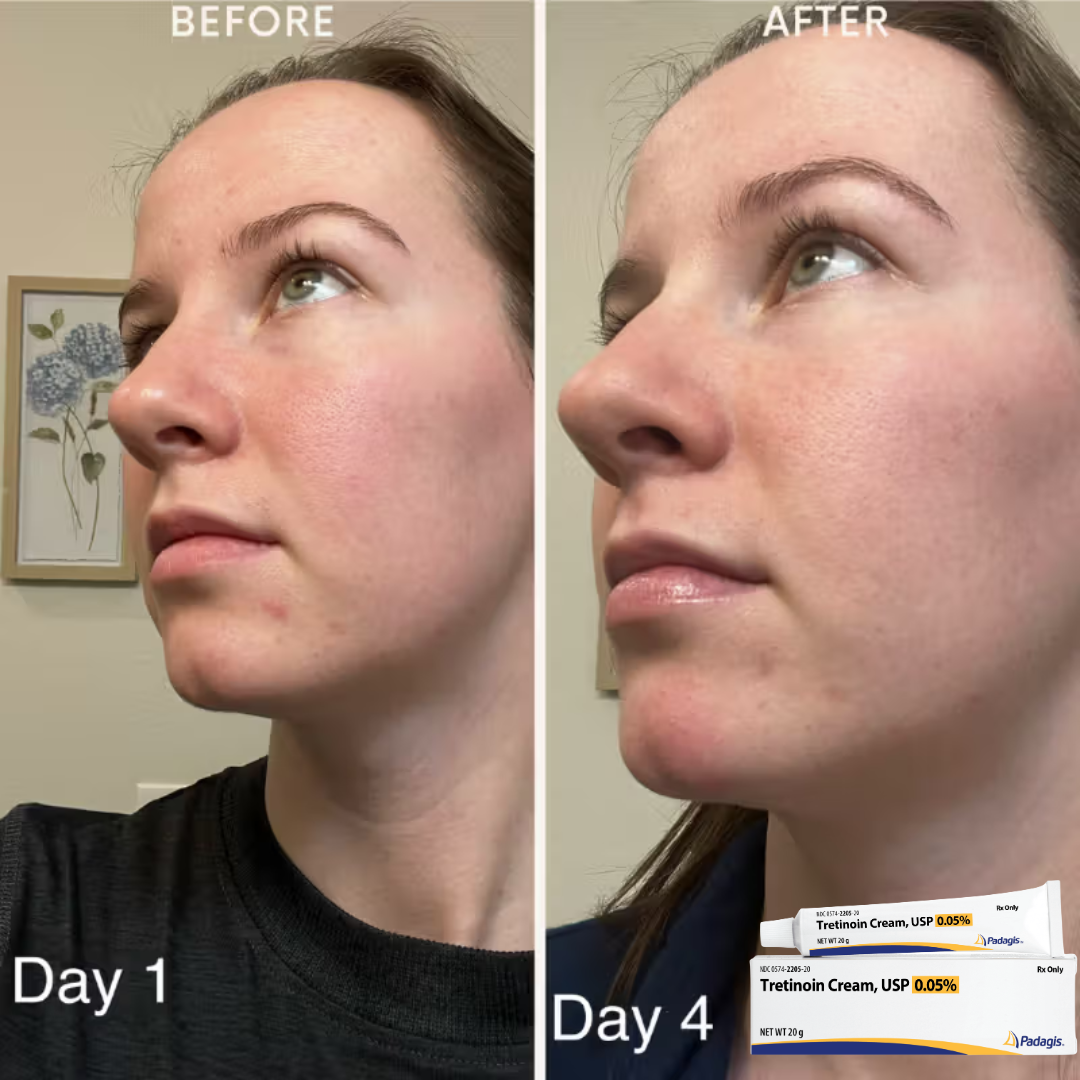 Tretinoin Cream USP