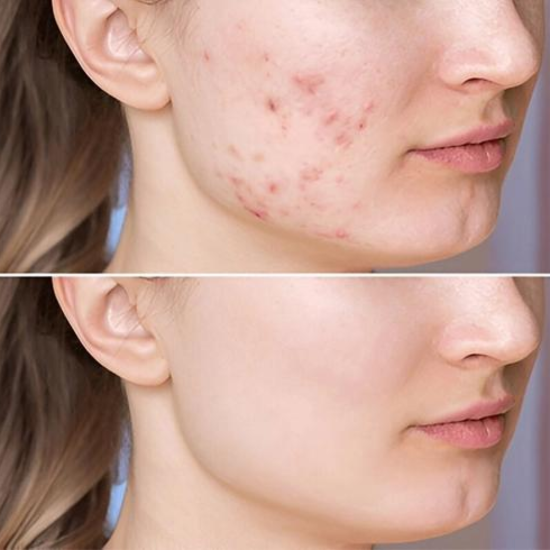 PD3 Regenerating Cream Max – Advanced PDRN Cream – Repair, Rebuild & Rejuvenate – Acne Scars & Skin Barrier Repair